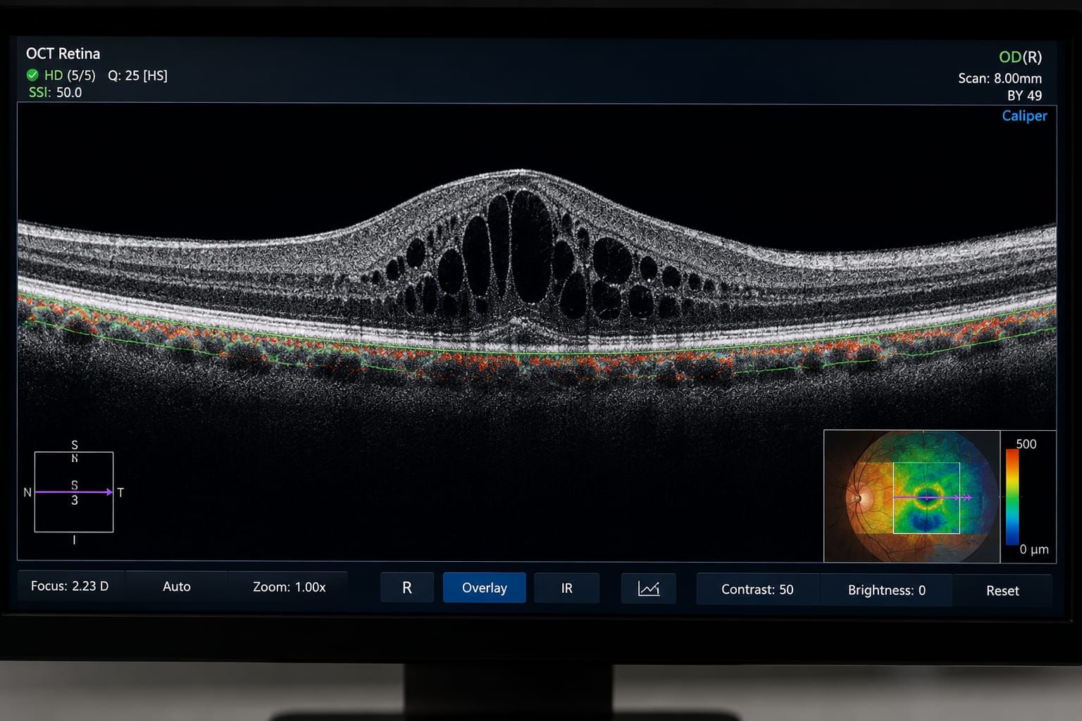 OCT maculaire avant injection intravitréenne à Errachidia