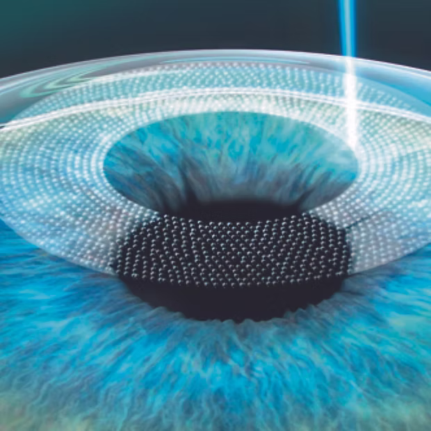 Femto LASIK pour la correction de la vue au laser à Errachidia